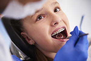 Dental Braces for Kids - 6 Things Parents Should Know